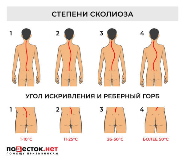 Берут ли в армию со сколиозом?