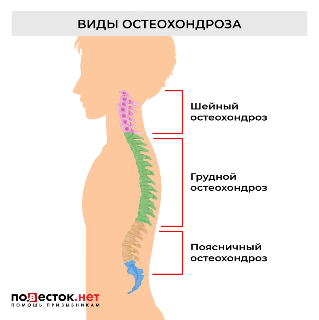 Берут ли в армию с остеохондрозом?